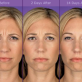 Facial Aesthetics - Wrinkle Reduction
